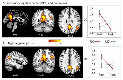 Altered Distant Synchronization of Background Network in Mild Cognitive Impairment during an Executive Function Task